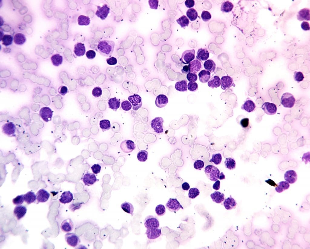 Peripheral blood smear showing numerous nucleated red blood cells and dysplastic myeloblasts in acute myeloid leukemia.