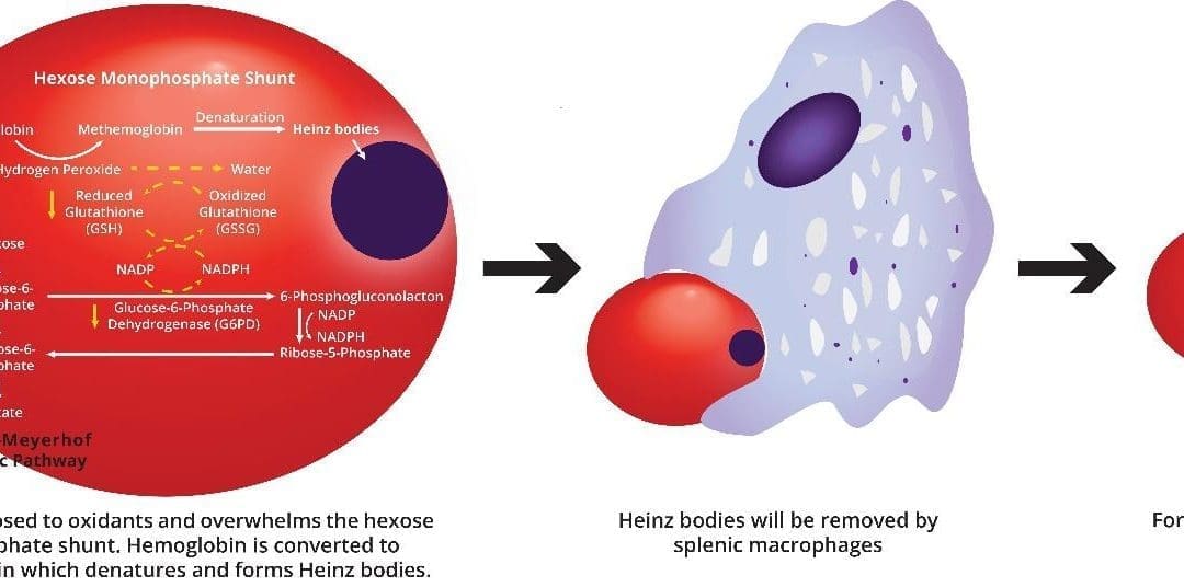 Glucose-6-phosphate dehydrogenase (G6PD) deficiency