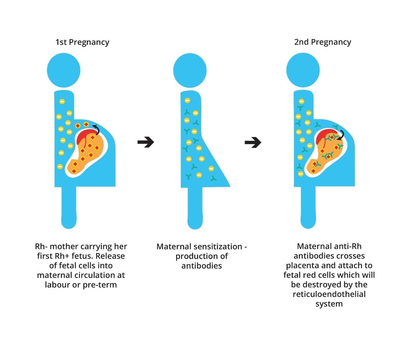 Hemolytic disease of the fetus and newborn (erythroblastosis fetalis), Rh incompatibility, ABO incompatibility, hemolysis, anemia