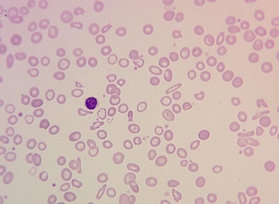 Iron Deficiency Anemia (IDA)