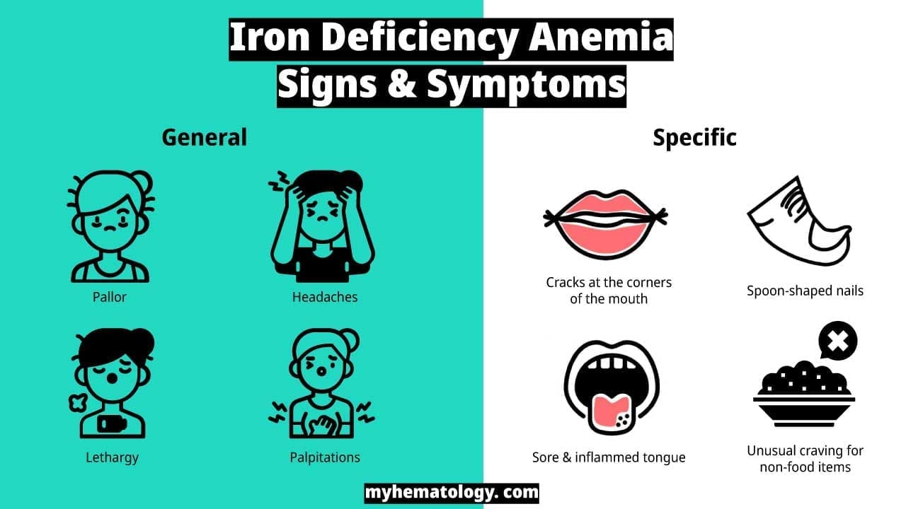 An infographic on the signs and symptoms of iron deficiency anemia.