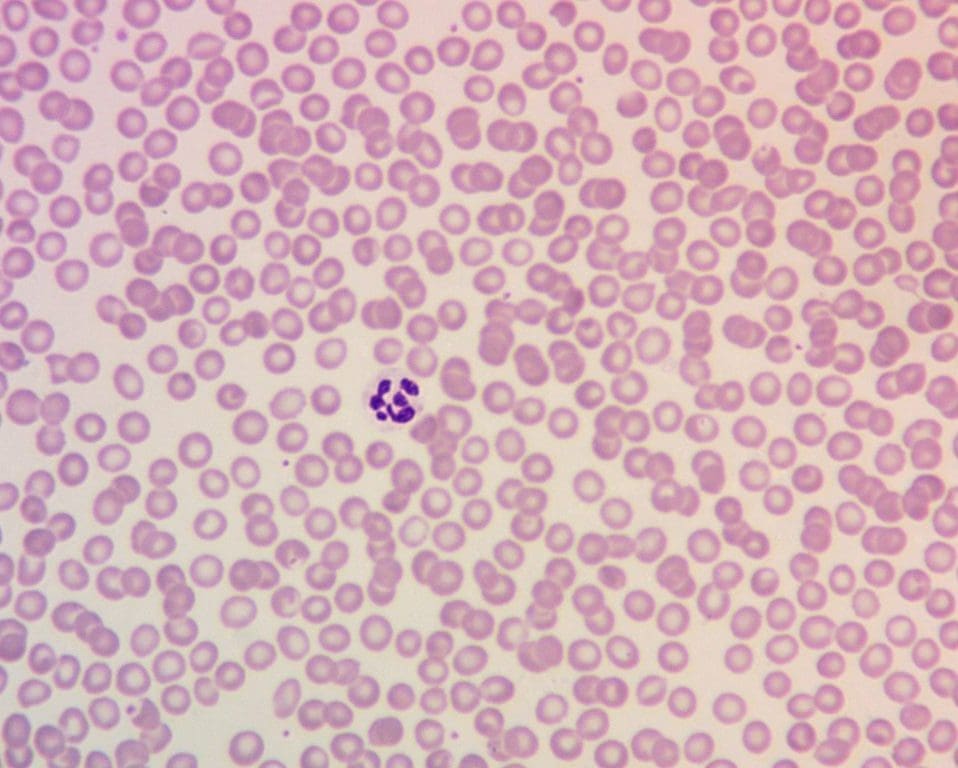 Image depicting a peripheral blood smear from a patient with megaloblastic anemia, highlighting the presence of hypersegmented neutrophils with six or more lobes