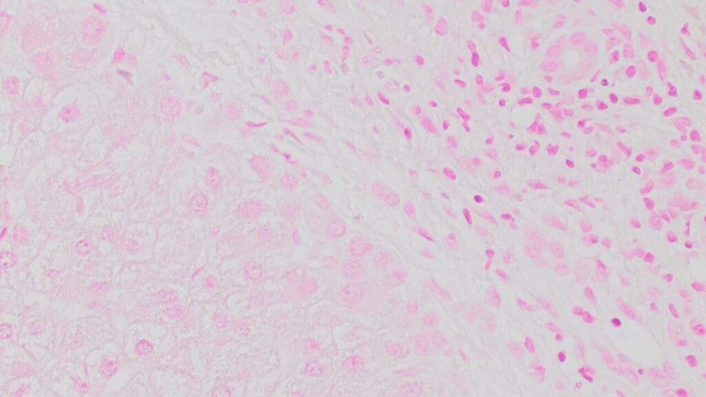Liver biopsy of chronic alcoholic cirrhosis stained using Prussian Blue Stain showed no evidence of iron overload.