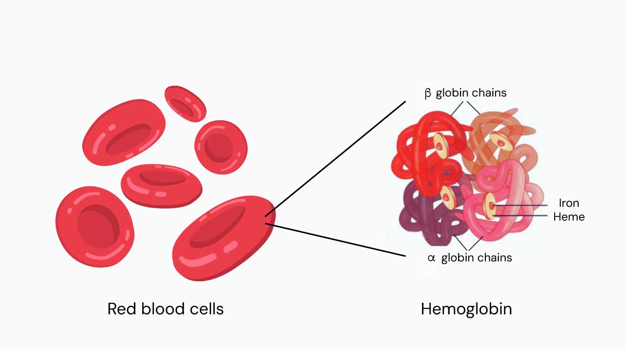 An illustration of a hemoglobin in a red blood cell. A single red blood cell can carry approximately 270 million hemoglobins. Each hemoglobin can bind up to four oxygen molecules. In beta thalassemia, a reduced quantity or absence of a functional hemoglobin will impair the oxygen that can be delivered to the tissues thereby leading to anemia.