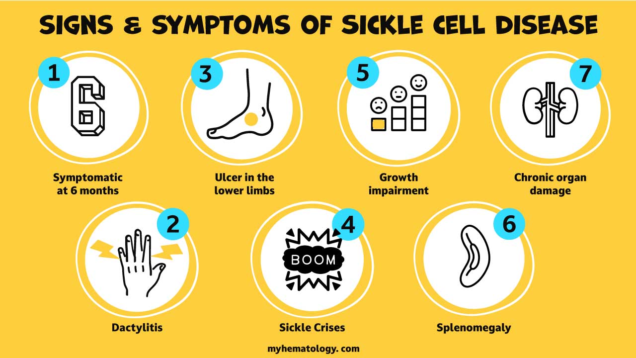 An infographic on the signs and symptoms of sickle cell disease