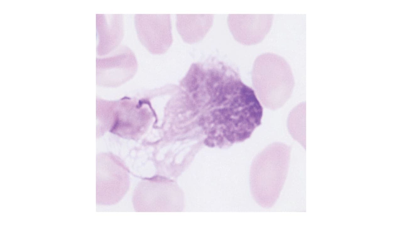 A smudge cell on the peripheral blood smear. Smudge cell is key characteristic of CLL.