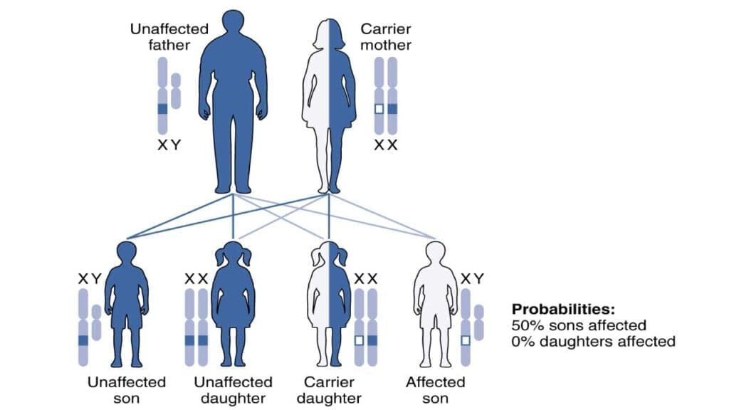 An illustration of the X-linked inheritance pattern in G6PD deficiency.