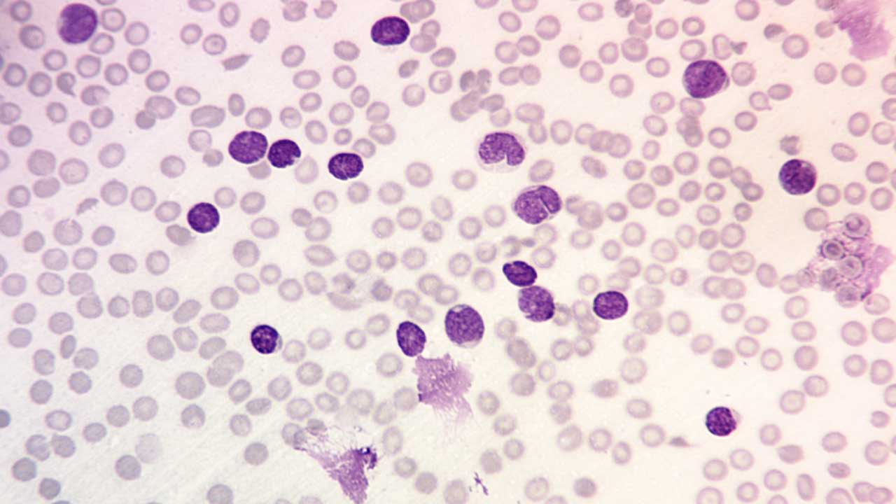 B-cell ALL: ALL peripheral blood smear with lymphoblasts and some smudge cells and also normochromic normocytic anemia and thrombocytopenia x 400 magnification.