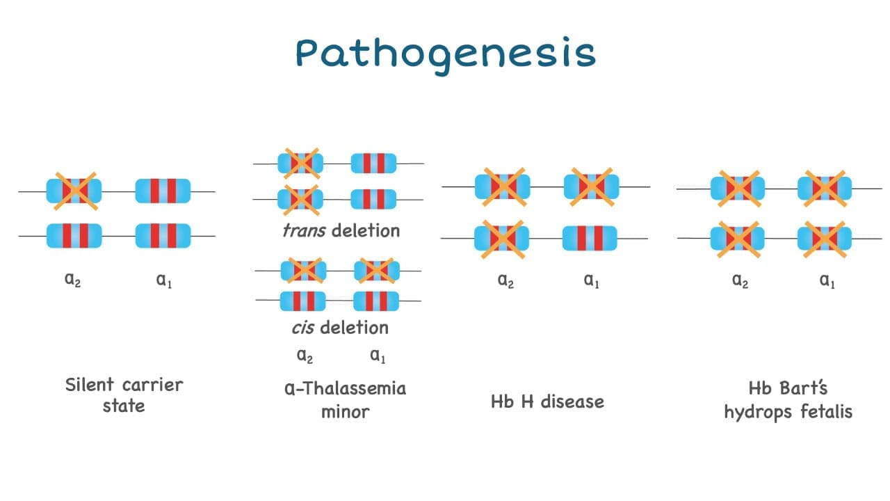 Alpha thalassemia pathogenesis based on the number of deleted alpha genes