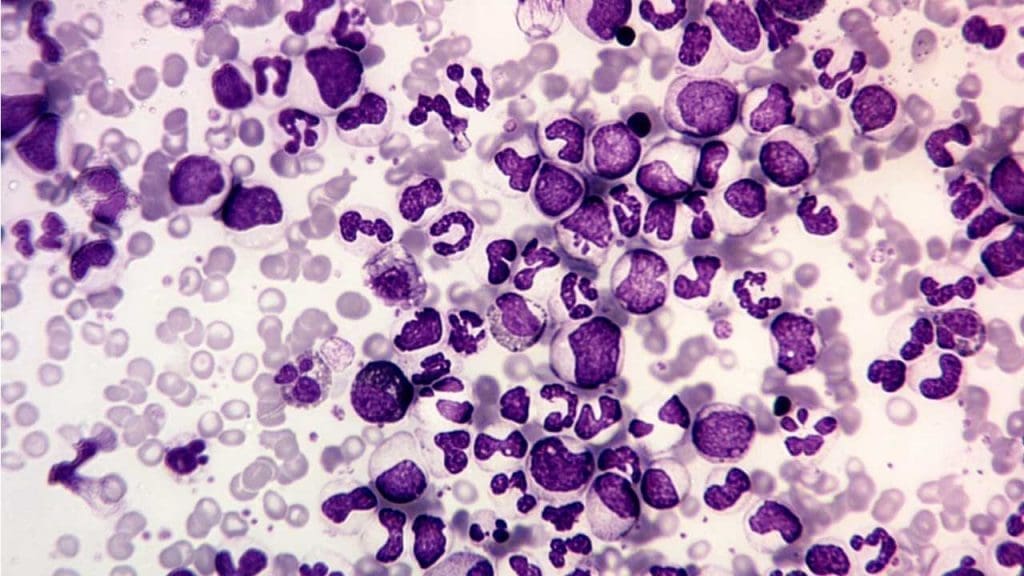 Image depicting a peripheral blood smear of chronic myeloid leukemia (CML), showcasing a left shift with immature granulocytes, basophilia, and eosinophilia