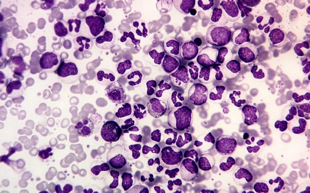 Chronic Myeloid Leukemia or CML