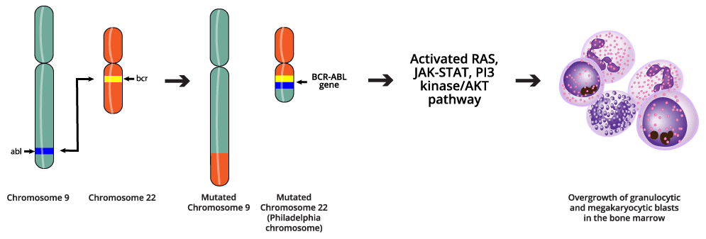 Unveiling the Molecular Mechanism of Chronic Myeloid Leukemia (CML): A Microscopic View of the Philadelphia Chromosome. Image depicting a microscopic view of a chromosome translocation resulting in the formation of the Philadelphia chromosome, a hallmark of CML.