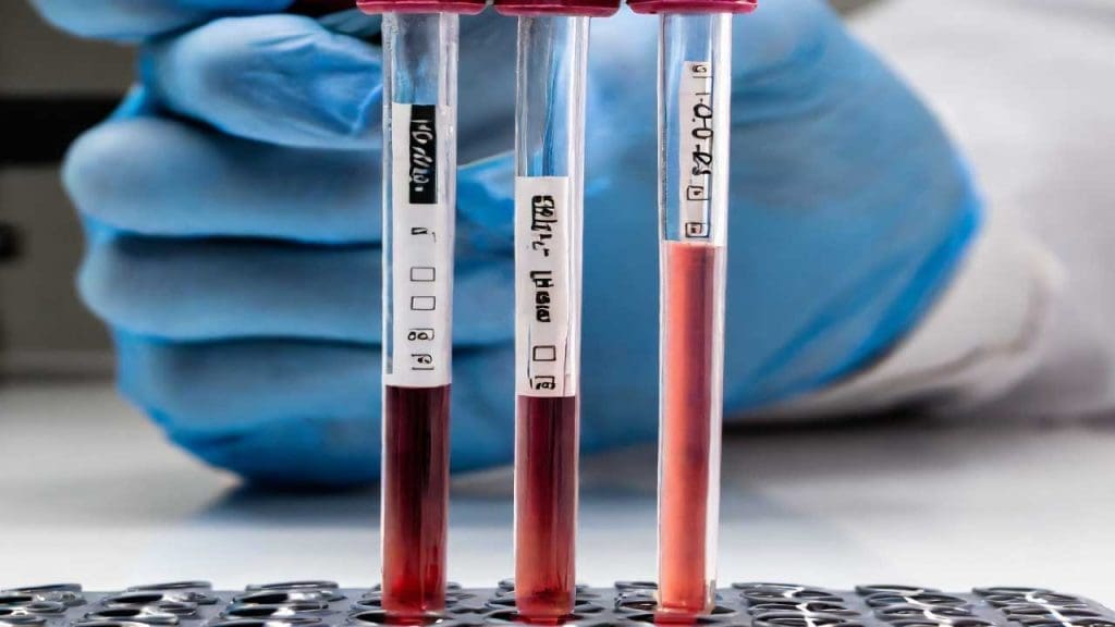 Image depicting a microscopic view of red blood cells settling in an ESR test tube, highlighting the impact of inflammation on red blood cell sedimentation rate.