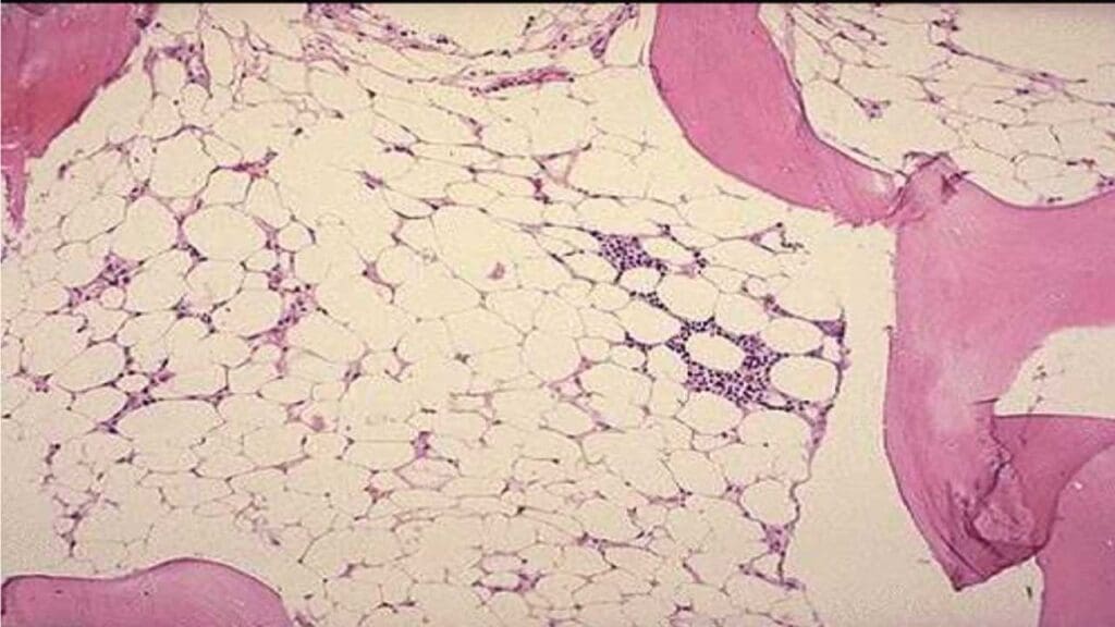 Hypocellular bone marrow seen in aplastic anemia.