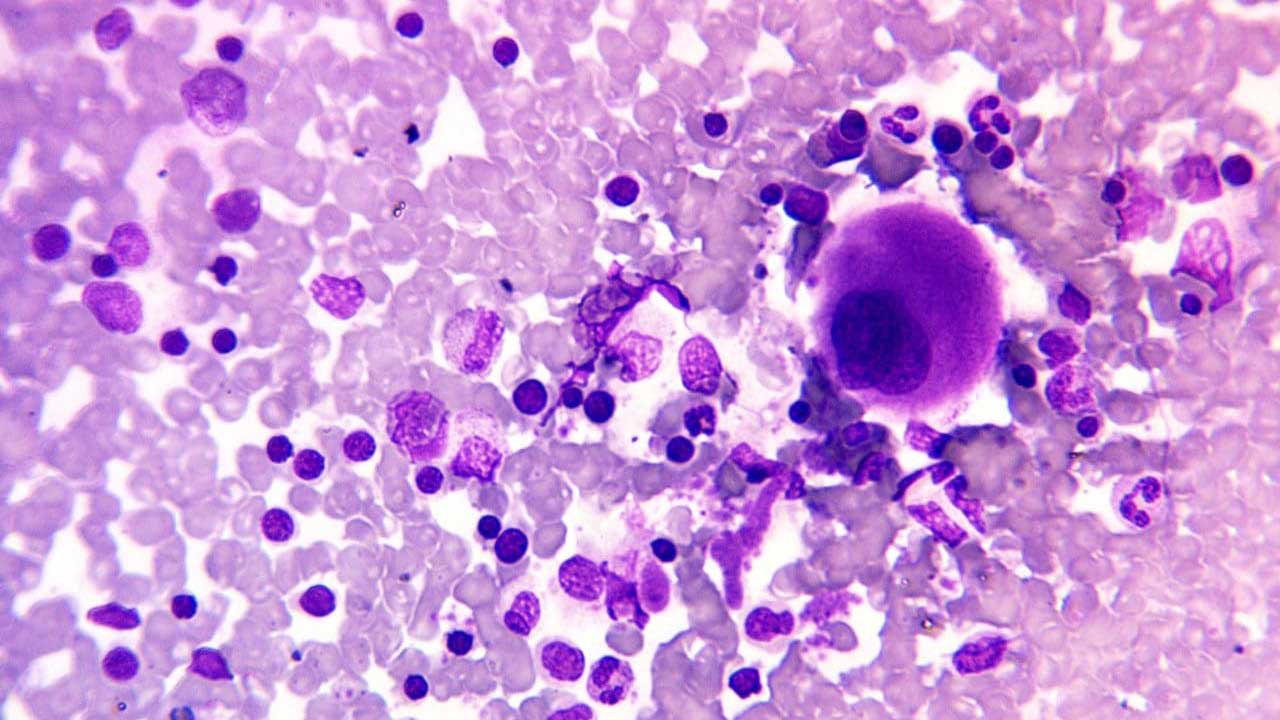 Visualizing the Cellular Landscape of Bone Marrow: May-Grünwald Giemsa (MGG) Stain Reveals Diverse Cellular Morphology (x400 Magnification)