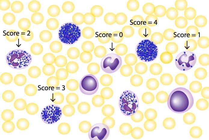 Leukocyte alkaline phosphatase stain peripheral blood smear evaluation. This image illustrates the LAP / NAP scoring system used to quantify neutrophils - whether they are mainly mature or immature cells.