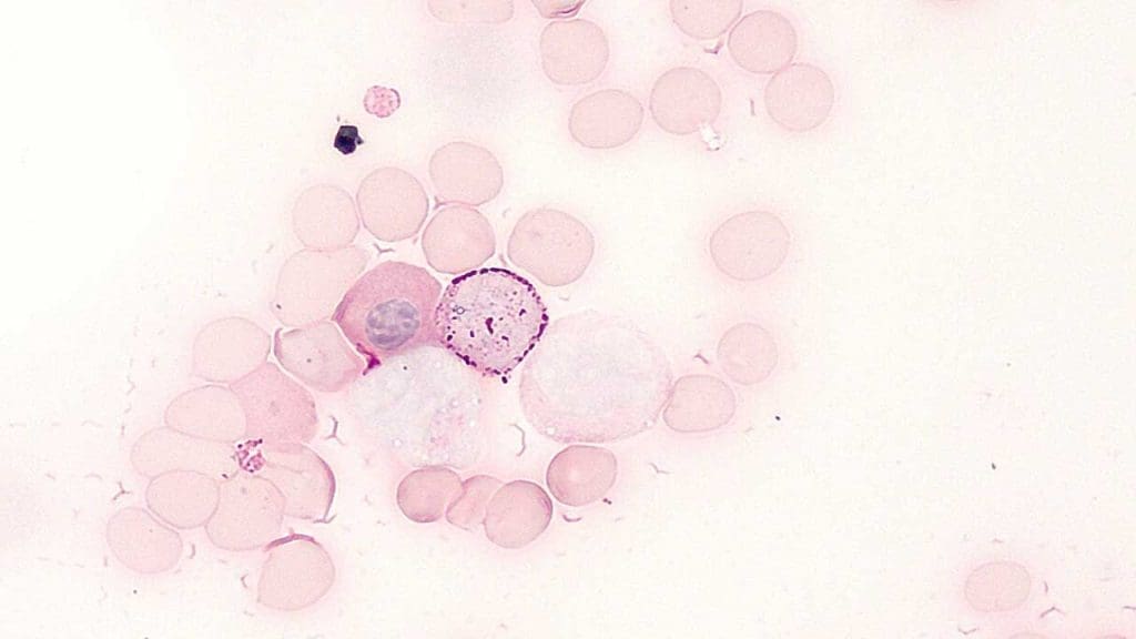 Bone marrow with B-ALL: PAS stain. Cell located upper-right to center contains crimson granules and fusion blocks, indicating B-ALL. "ALL PAS stain" by Animalculist is licensed under CC BY-SA 4.0.