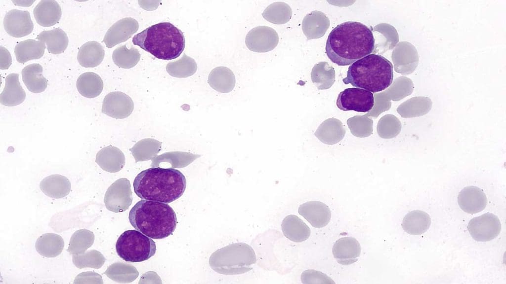 Minimally differentiated acute myeloid leukemia cells have no distinctive morphological differences from normal myeloblasts in AML M0.