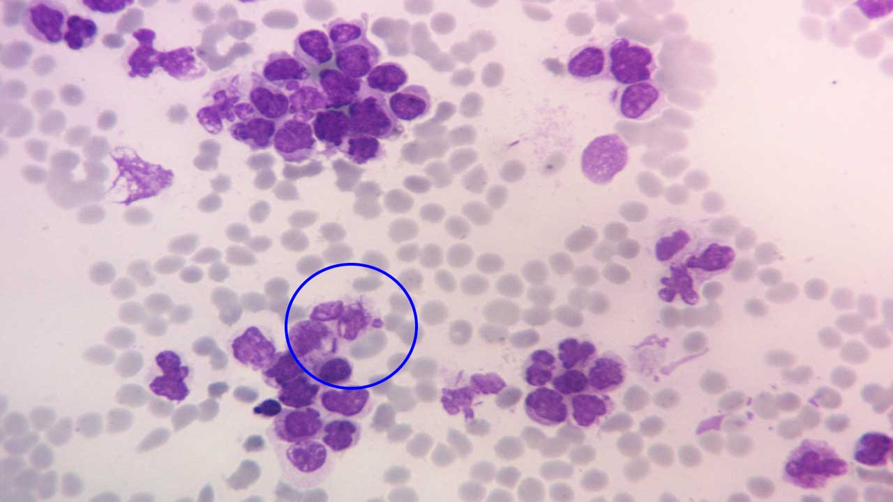 Microscopic view of acute myeloid leukemia (AML) showcasing characteristic needle-shaped Auer rods within myeloid cells. (MGG stain, magnification x 400)