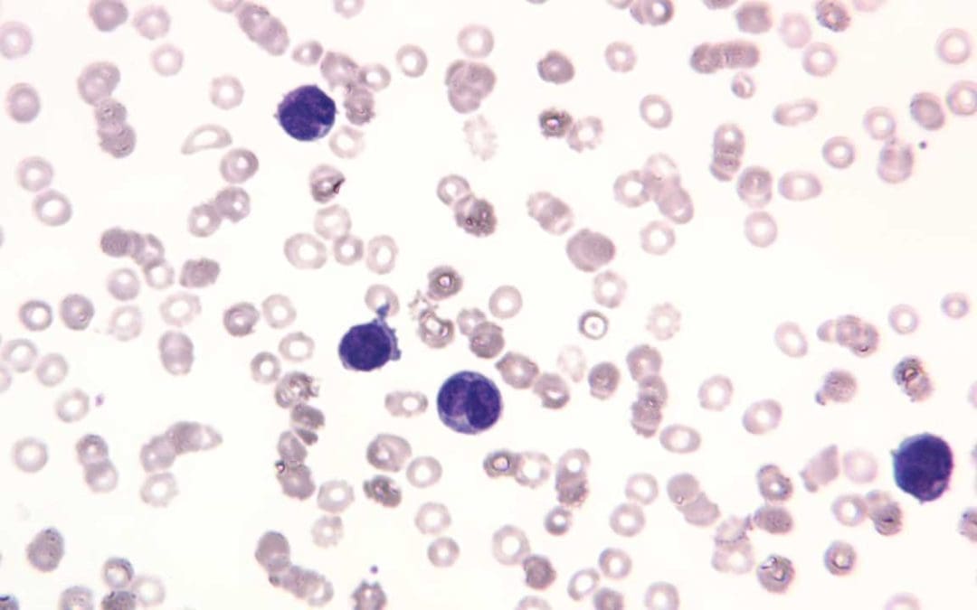 Leukemia: An Overview