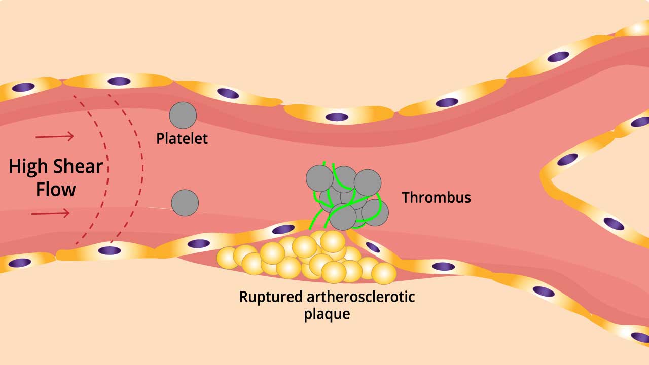 The pathophysiology of arterial thrombosis including artherosclerosis formation, plaque rupture, clot formation and thickening of vessel wall in arterial thrombosis