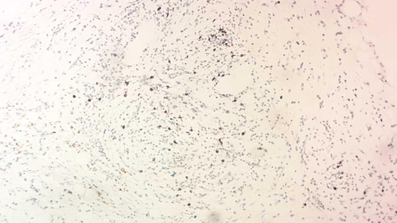 Microscopic view of a bone marrow biopsy showcasing a brown-stained CD20-positive B lymphocyte. This marker can reveal B-cell malignancies like lymphoma, aiding in accurate diagnosis.