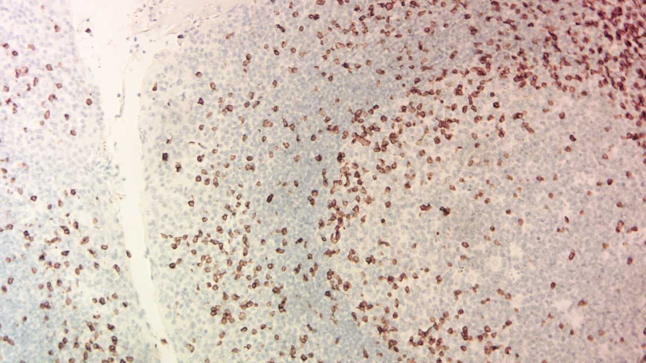 Microscopic image of a bone marrow trephine biopsy showcasing a CD3-positive T lymphocyte (brown stain) amidst other blood cells using IHC staining method.