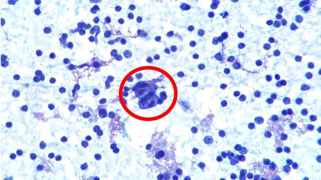 Hemato-oncology: Presence of Reed-Sternberg cell in the fine needle aspirate of a lymph node.