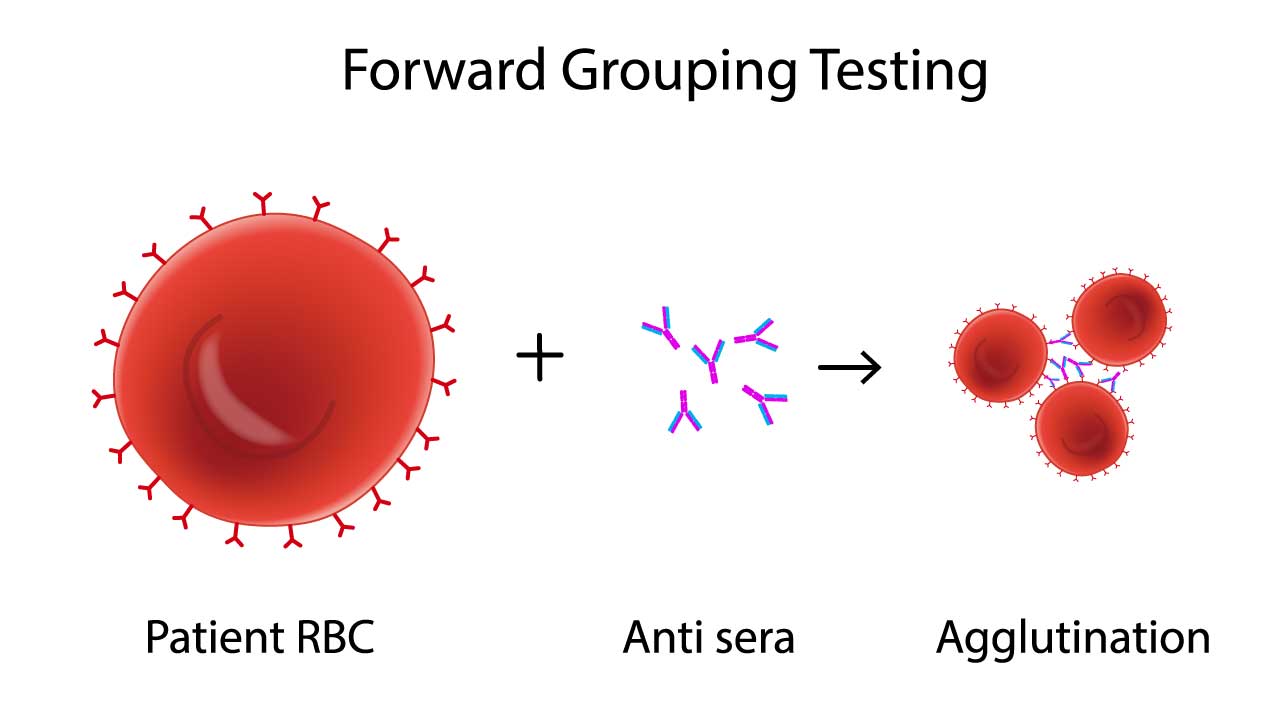 Image illustrating the principle of forward blood group testing, highlighting antigen-antibody interactions in ABO Rh test (blood group typing)