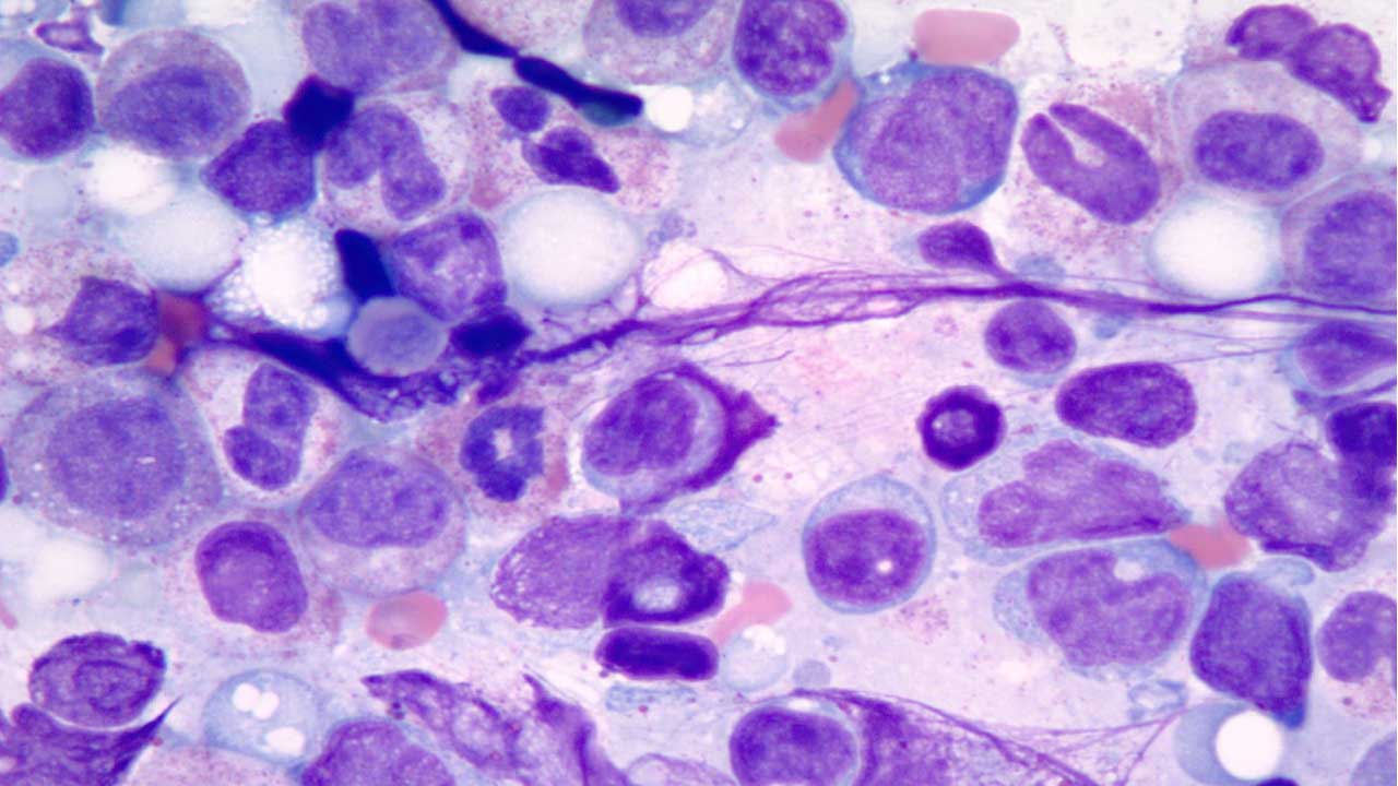 Myelodysplastic Syndromes (MDS)