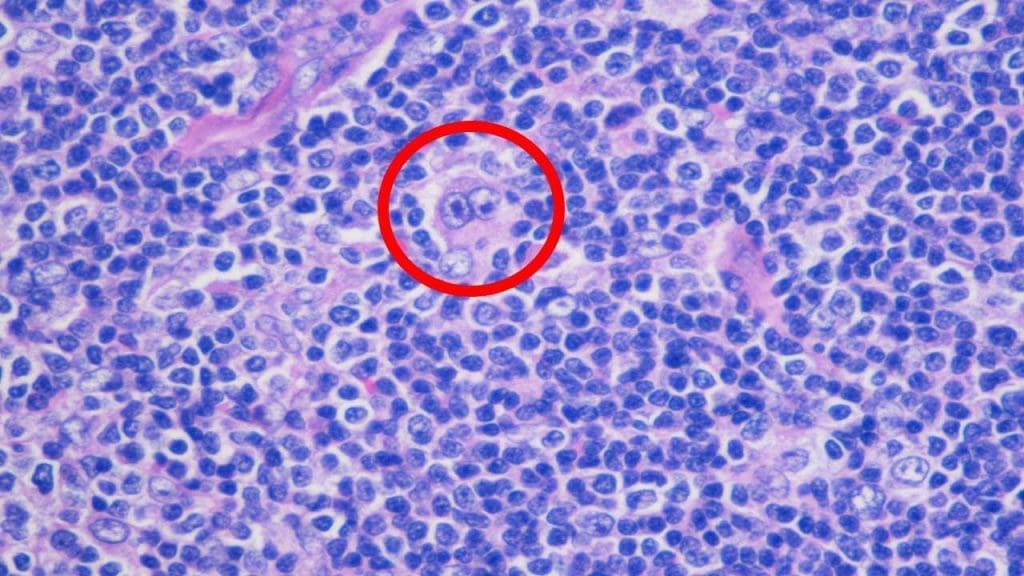 Reed-Sternberg cells in a lymph node biopsy indicating Hodgkin lymphoma, a hematology-related cancer.