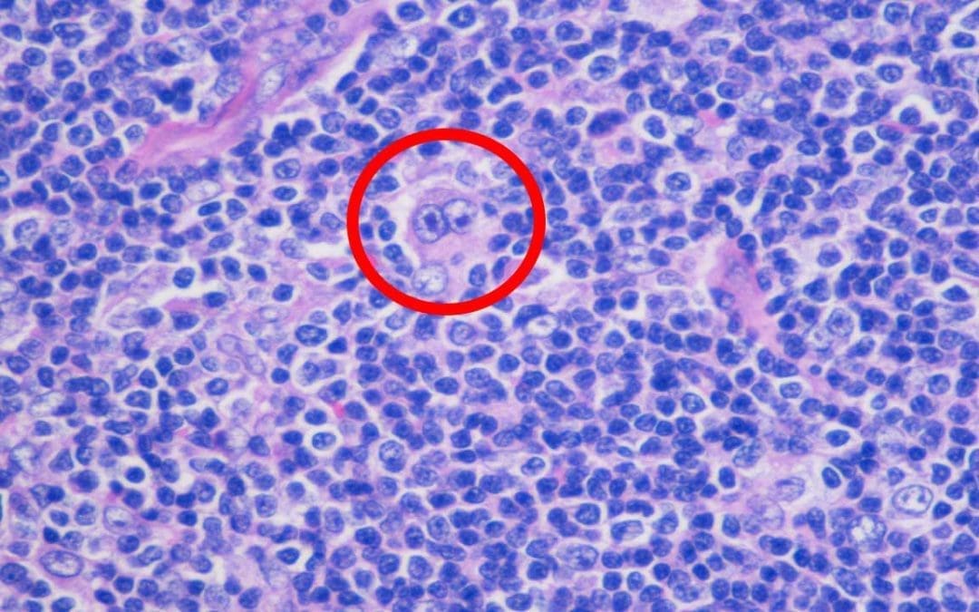 Hodgkin Lymphoma (Hodgkin’s Disease) & Reed-Sternberg Cells