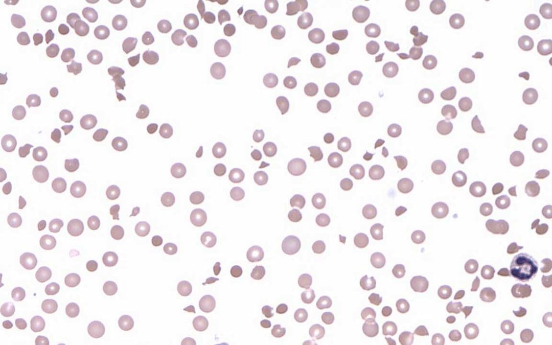 Thrombocytopenia