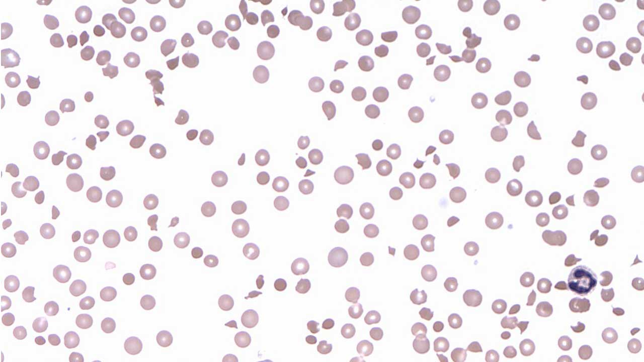 Thrombocytopenia