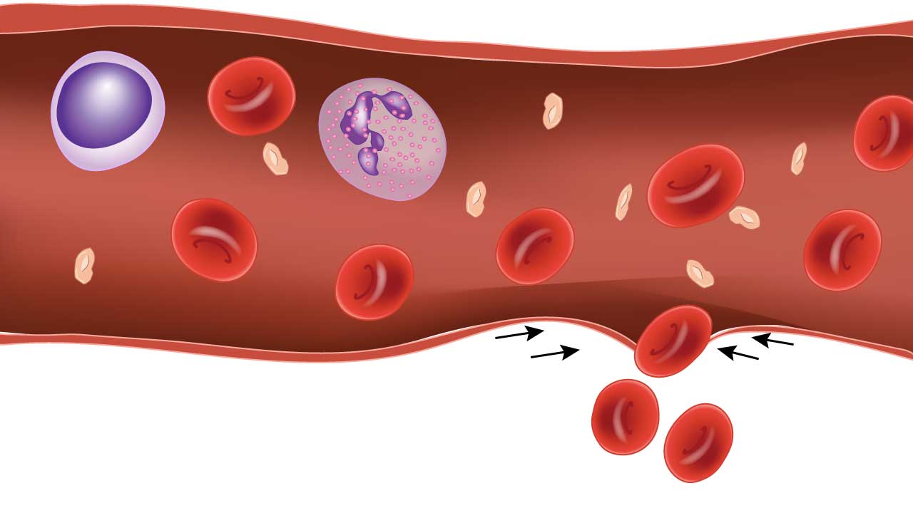 Vasoconstriction, an early stage of primary hemostasis, reduces blood flow to heal a wound