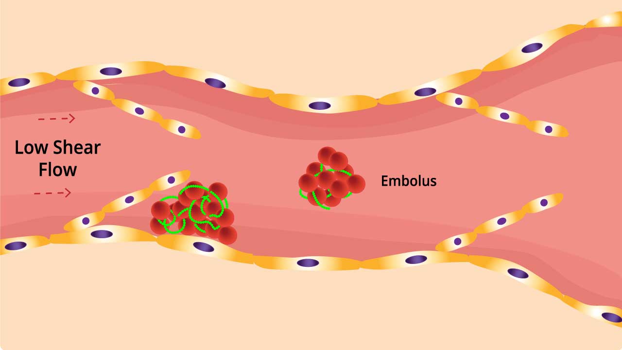 Inside venous thromboembolism or VTE: Blood flow slows, platelets clump, fibrin mesh traps cells, forming a clot. Breakaway clot can travel to lungs, leading to life-threatening pulmonary embolism (PE).