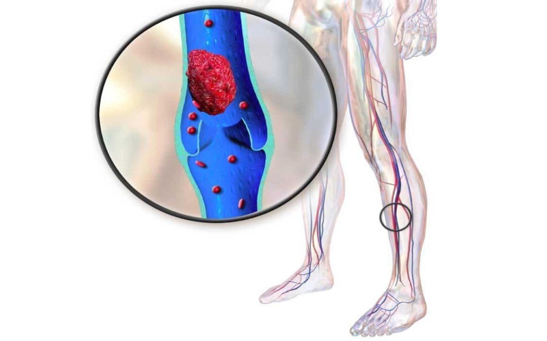 Deep Vein Thrombosis (DVT)