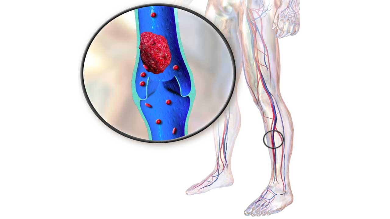 Deep Vein Thrombosis (DVT)