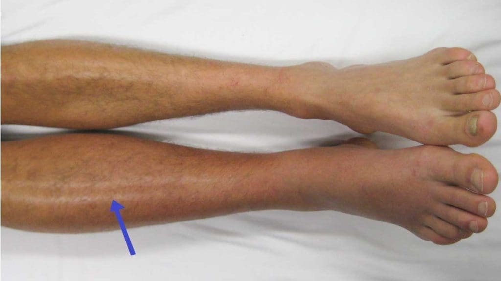 Deep vein thrombosis - DVT in the right leg causing swelling and redness compared to the left leg.