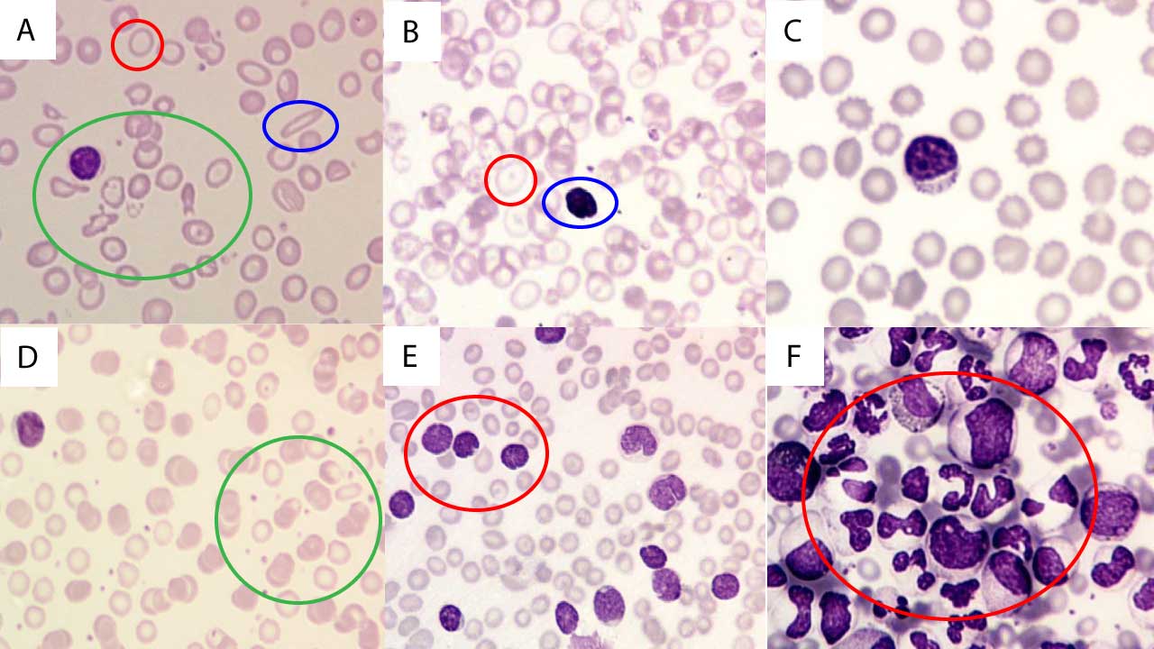 Peering through the microscope lens at a Leishman-stained blood smear reveals a colorful landscape teeming with diverse cellular morphologies. Red blood cells, typically appearing biconcave and pinkish-orange, dominate the scene. White blood cells, each with their unique characteristics, steal the show: lymphocytes with their round, deeply stained nuclei and scant cytoplasm; segmented neutrophils adorned with delicate purple granules; monocytes boasting abundant blue cytoplasm; and eosinophils, readily identified by their large, orange-red granules.