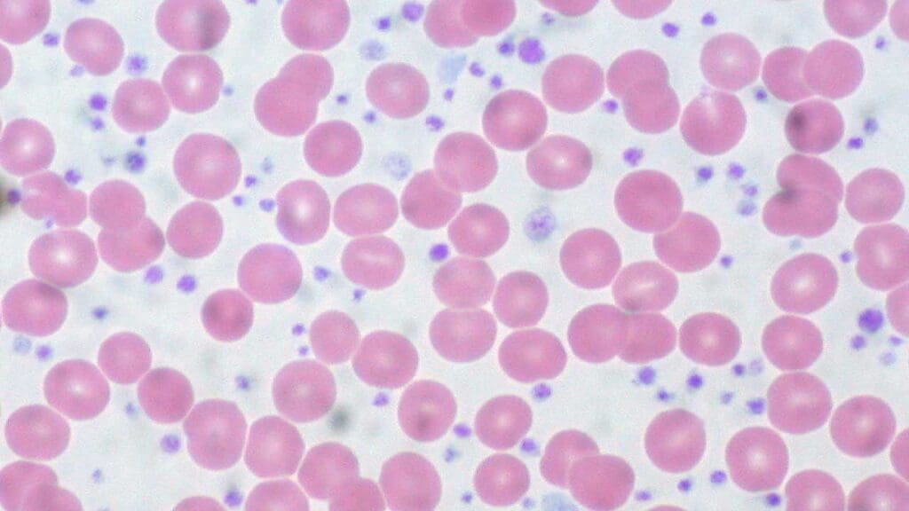 Elevated platelet count with presence of giant platelets in essential thrombocythemia (ET). ET is a type of myeloproliferative neoplasm (MPN). 