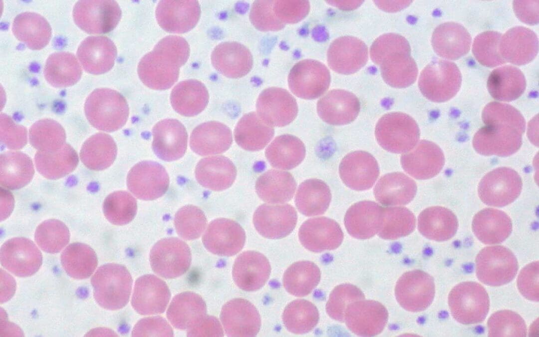 Essential Thrombocythemia (ET)