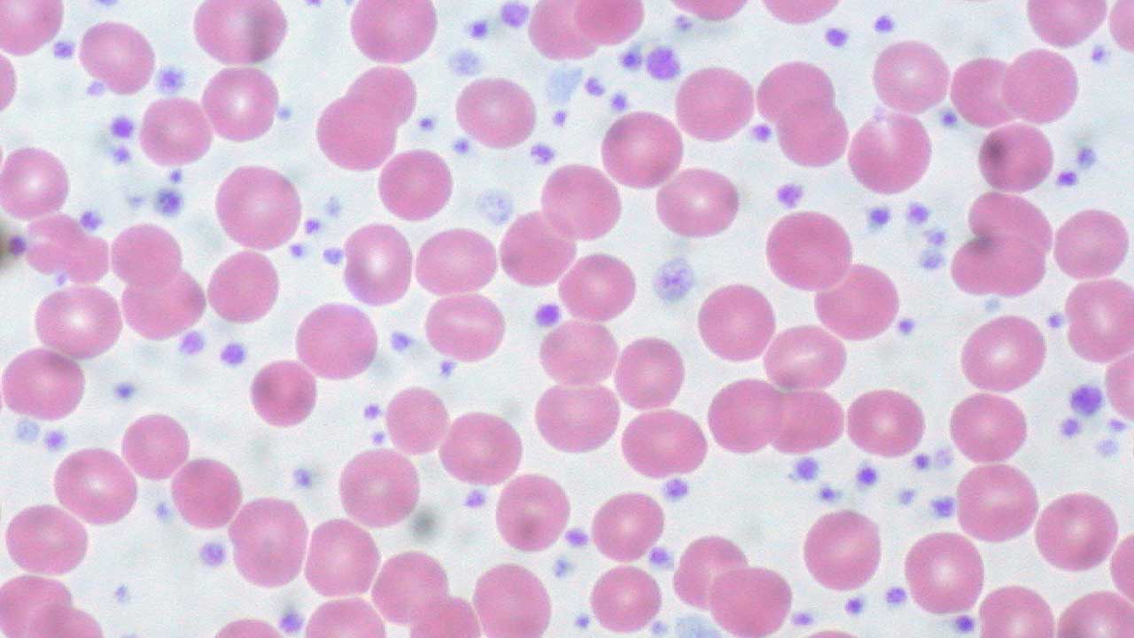 Essential Thrombocythemia (ET)