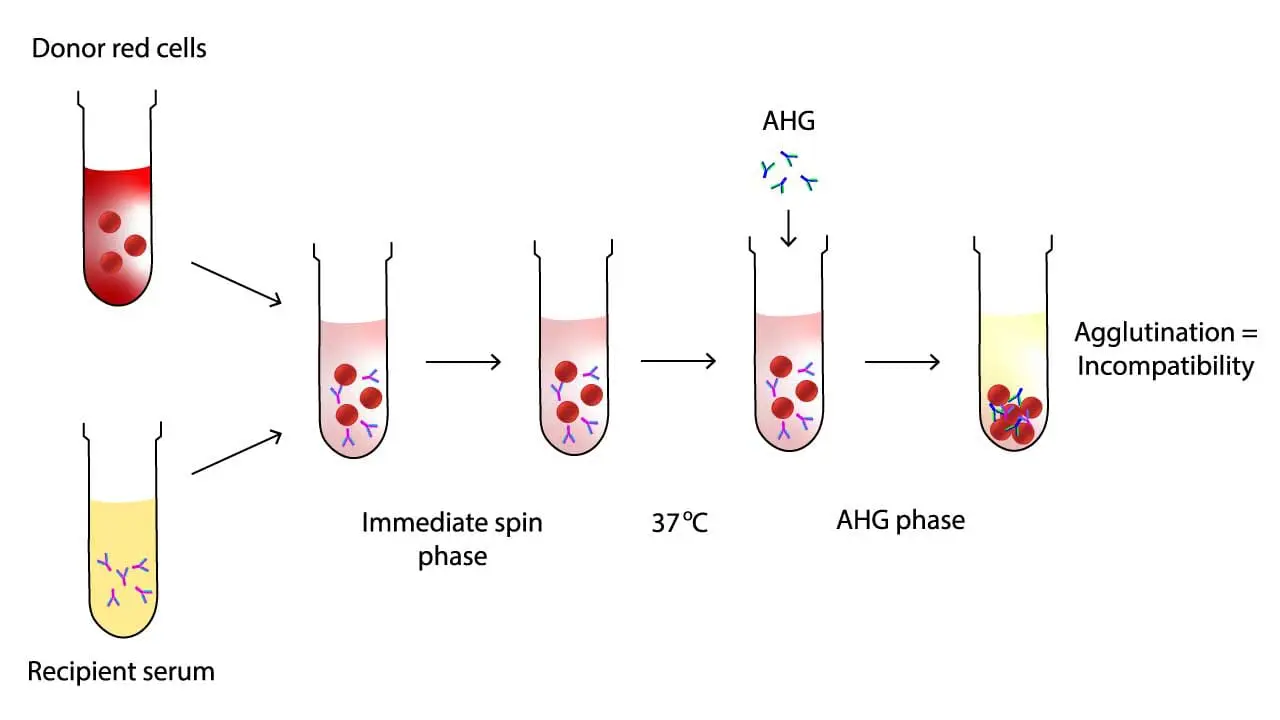 The serological cross-matching (blood compatibility test) acts as the final guardian of transfusion safety. It verifies ABO blood compatibility and hunts for hidden dangers like antibodies that might've slipped past initial screening. It mixes recipient serum with donor red blood cells, checking for immediate reactions like clumping (agglutination) or breakdown (hemolysis). If these occur, it indicates an incompatible match, prompting further investigation. Conversely, no agglutination in a patient with a negative antibody screen signifies a compatible match, greenlighting the transfusion.