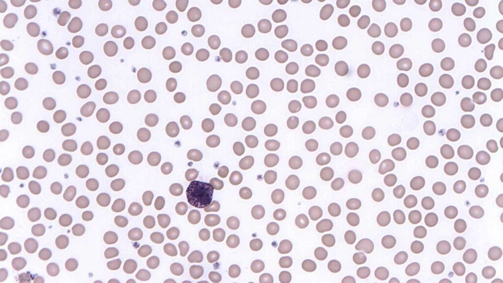 A basophil found in the peripheral blood smear. Basophils have large deep bluish-purplish cytoplasmic granules which obscure the nucleus.