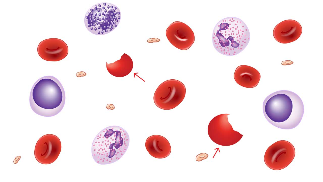 Diagram of various blood cells, including several red blood cells with crescent-shaped indentations on their sides, resembling bites taken out of a cookie. These are bite cells (schistocytes) red blood cell morphology and can indicate mechanical damage to red blood cells. The text describes their association with G6PD deficiency, where damaged cell components are removed by macrophages, leaving the characteristic bite-like shape.