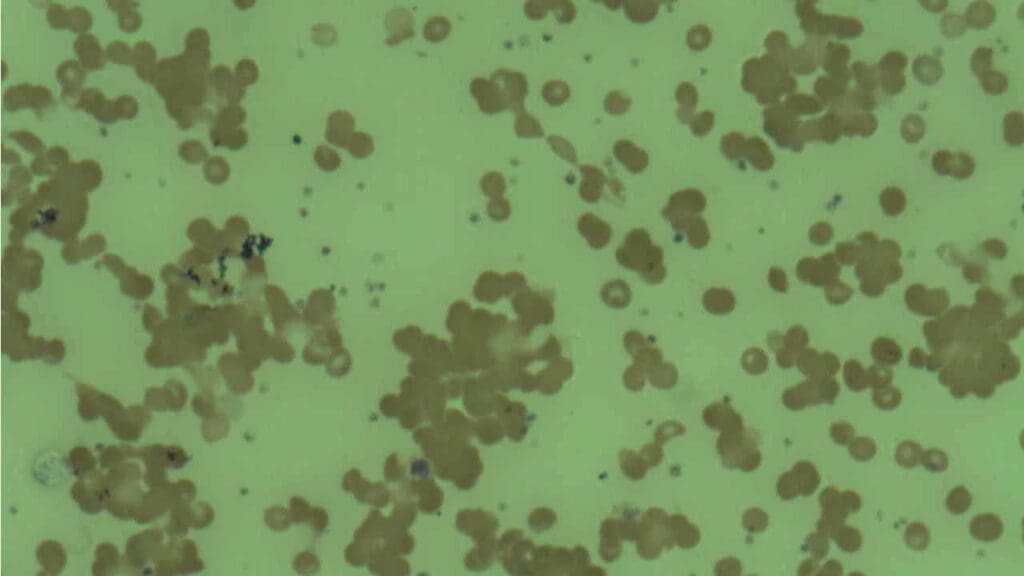 Red cell agglutination in a peripheral blood smear of a patient with CAD 