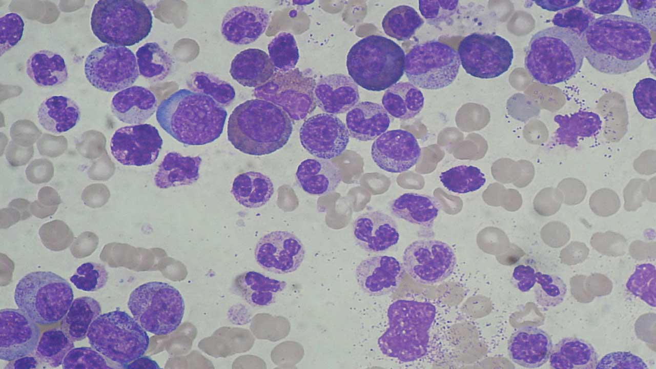 Leukocytosis