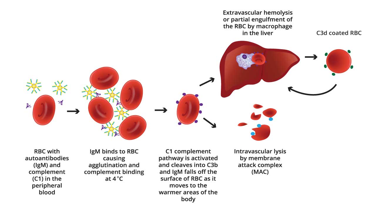 Pathophysiology of cold agglutinin disease in autoimmune hemolytic anemia (AIHA).