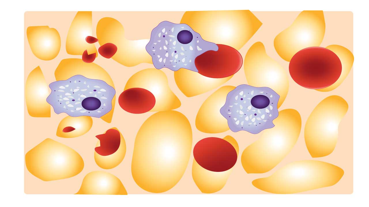 Diagram of extravascular hemolysis. A red blood cell is being engulfed by a macrophage, a large immune cell, within the spleen. The spleen is an organ that filters blood and removes old or damaged cells.